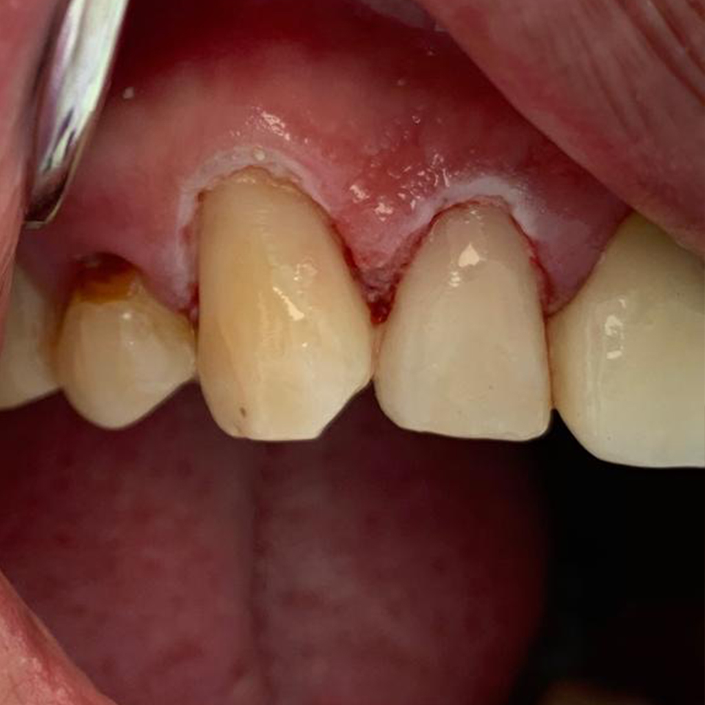 Rehabilitación completa dental, foto despues de aplicado el tratamiento