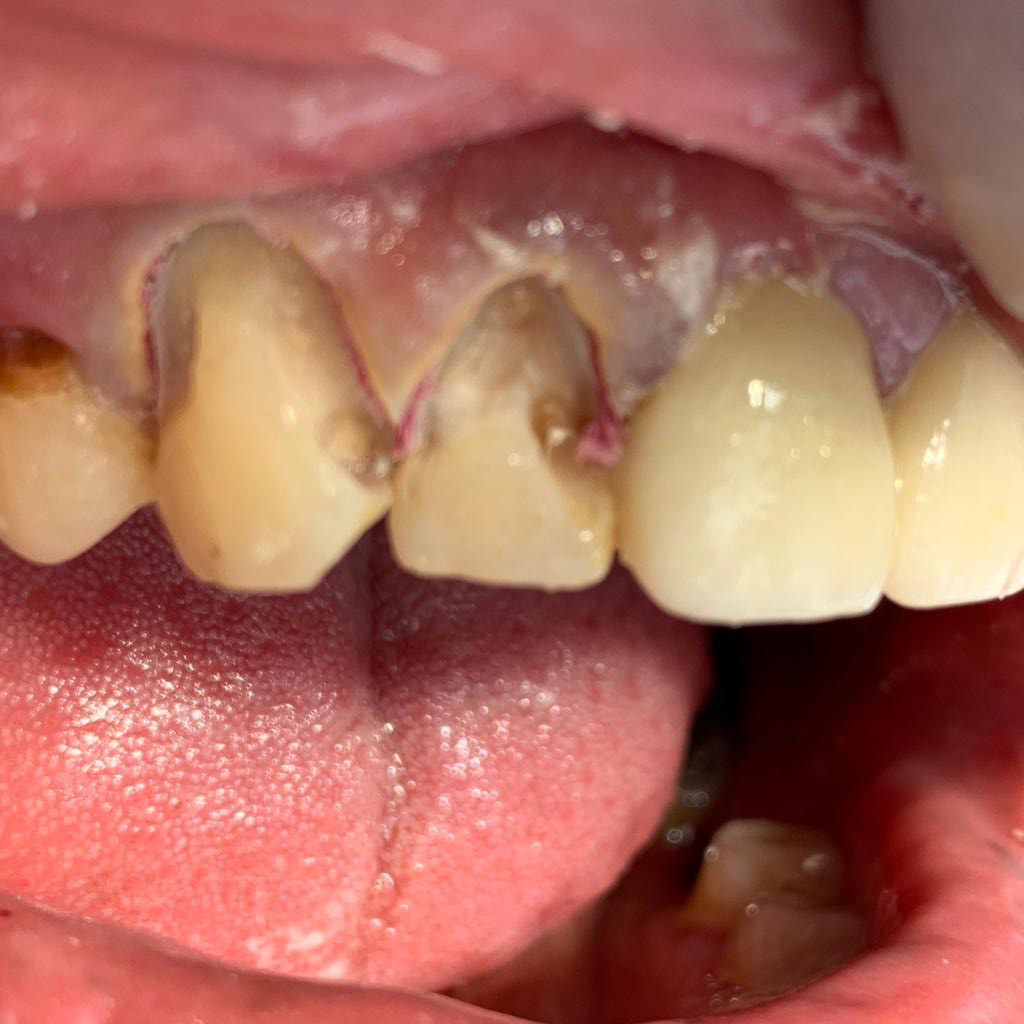 Rehabilitación completa dental, foto antes de tratamiento